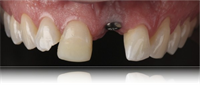 Mastering Dental Implant Restorations and Aesthetics - #smilestories