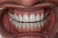 Overcontoured Teeth: The Fifth Violation of Smile Design