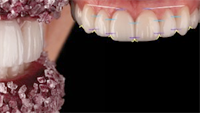 Gum Symmetry: The Seventh Violation of Smile Design