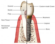Root Canal Retreatment or Implant?