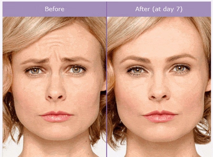 Botox Is The Fountain Of Youth