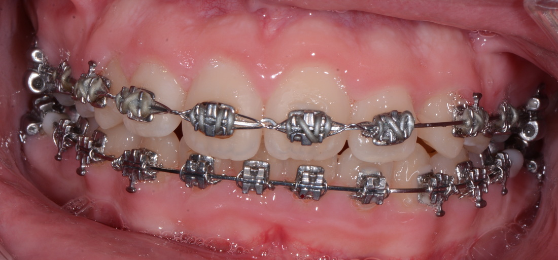 Yes! Accept Transfer Orthodontic Cases! (Most of the time.) Part II