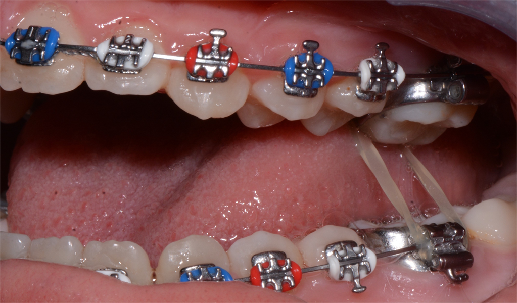 Ortho Case Finishing: The In-Treatment-Presenting-Posterior Crossbite
