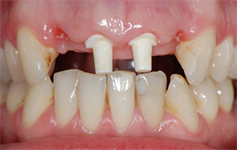 Dentaltown Learning Online- "Ceramic Dental Implants in Everyday Practice" byDan Hagi DDS, FAGD, FICOI, (A)FAAID