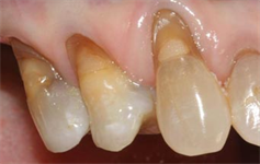 Dentaltown Learning Online..."Restoration of Non-Carious Cervical Lesions" by John J. Maggio, DDS.