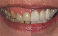 Dentaltown Learning Online- The Aesthetic Full Mouth Rehabilitation by Dr. John Nosti 