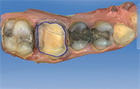 Dentaltown Learning Online ..."Same-day Dentistry: Integration of CAD/CAM Technology in Your Office. Recorded Live at Townie Meeting 2014!" by Dr. Dhaval Patel. 