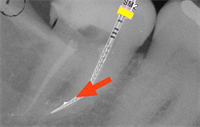 Dentaltown Learning Online..."Reciprocation - An Optimal New Paradigm in Root Canal Preparation" By Gianluca Plotino DDS, PhD; Nicola Maria Grande DDS, PhD; Prof Gianluca Gambarini, MD, DDS 