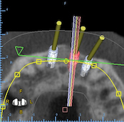 Dentaltown Learning Online....Realizing the Magic of Guided Surgery" By Sheldon Lerner