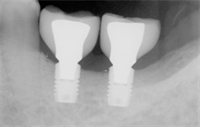 Dentaltown Learning Online....."Short Implants; Does Size Really Matter?" by Dr. Bill Schaeffer 