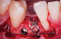 Dentaltown Learning Online....Use of Guided Bone Regeneration in a Dental Practice by Dr. Kris Chmielewski 