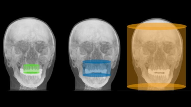 3D Cone Beam Dental Equipment Guide: How to Select Field of View (FOV)