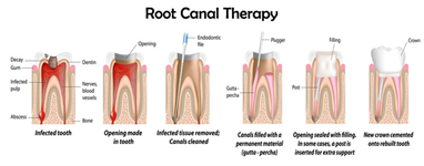 How Dentist Can Save Time While Using Latest Equipment For Root Canal Therapy