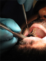How to Deal with a Dental Emergency