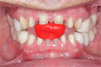 "How to articulate full mouth rehabs when preparing teeth at the same time"