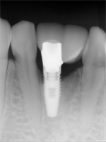 What to do when you only have room for one implant?