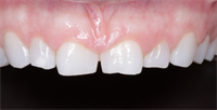 How Do You Know When Your Patient Needs Crown Lengthening?