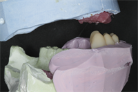 Set Denture Teeth Like a Pro: Analyze Restorative Space!!