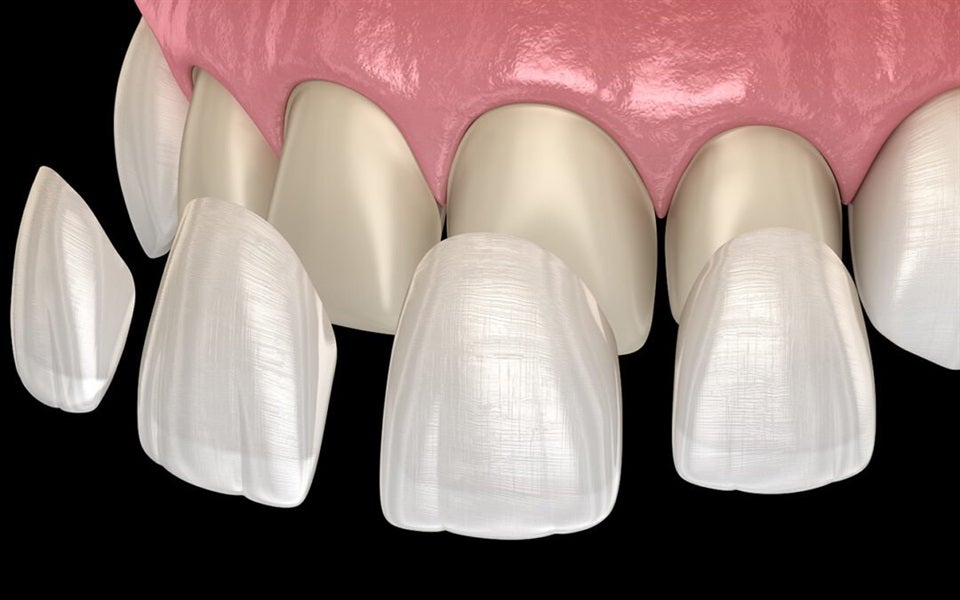 What Are The Main Differences Between Veneers and Lumineers?