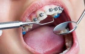 Brace Yourself: Understanding Orthodontic Treatments