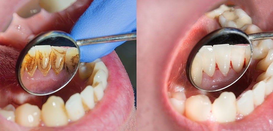 Tackling Gum Disease for a Healthier Smile