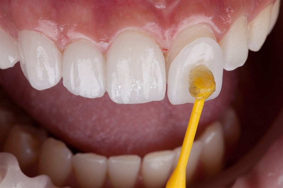 Give Your Teeth a Makeover with Veneers