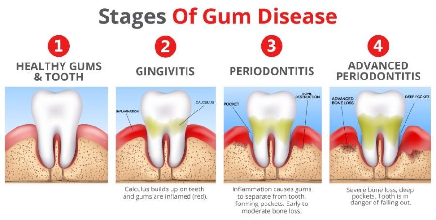 Please get to the Root of It: Common Causes of Gum Disease