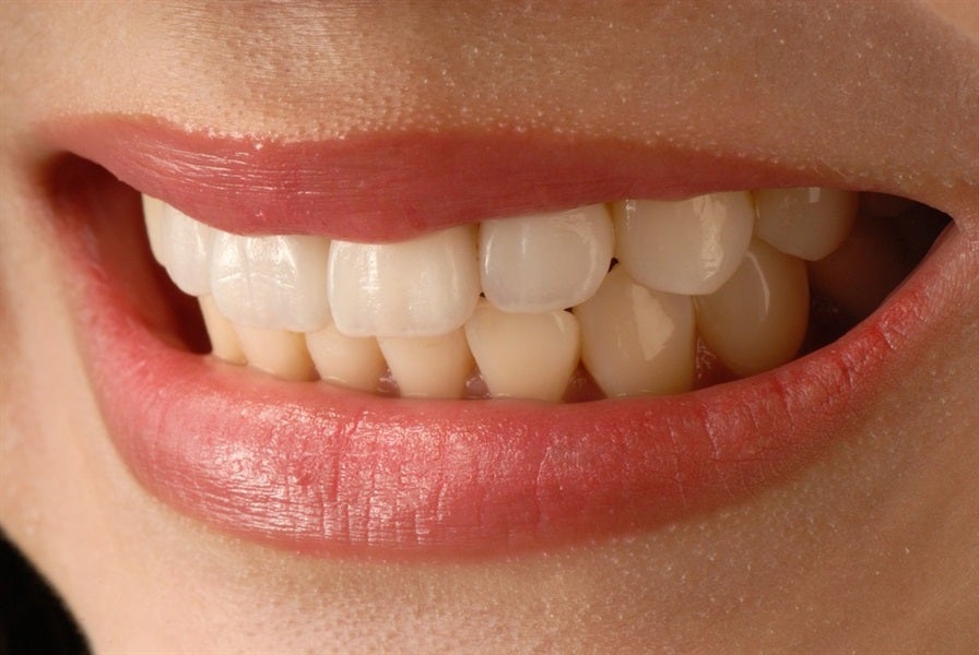 Everything You Need to Know About Veneers Dental Concerns