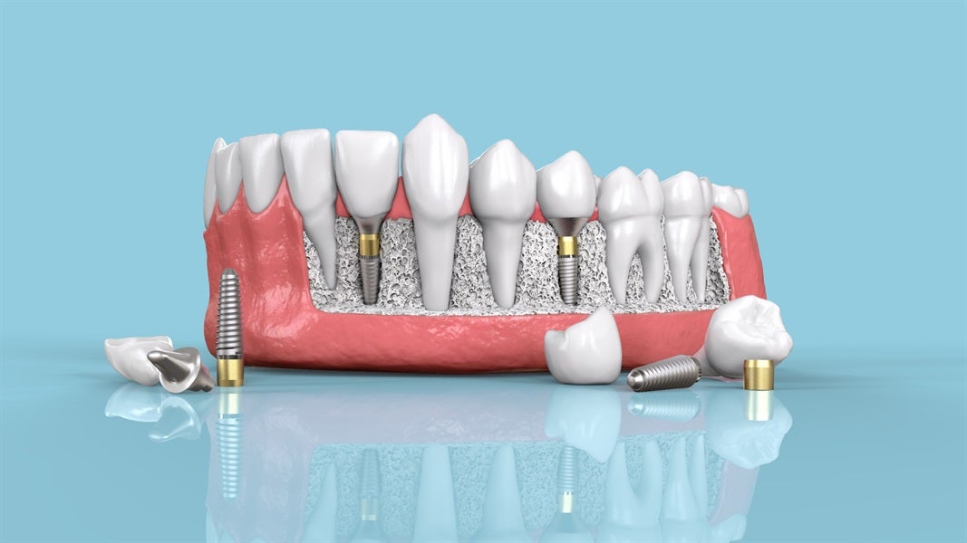Expanding Access to Dental Implants: North Garland Dental and Orthodontics Pioneers Affordable Solutions