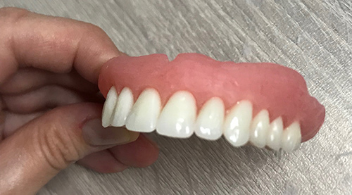Finishing Denture for All-On-4 Conversion