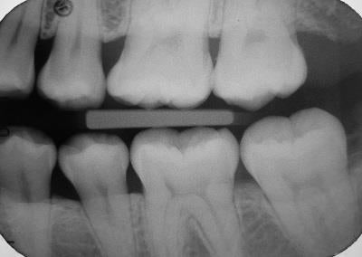 Dental Radiographs - Part 1: Bite-Wings and Periapicals