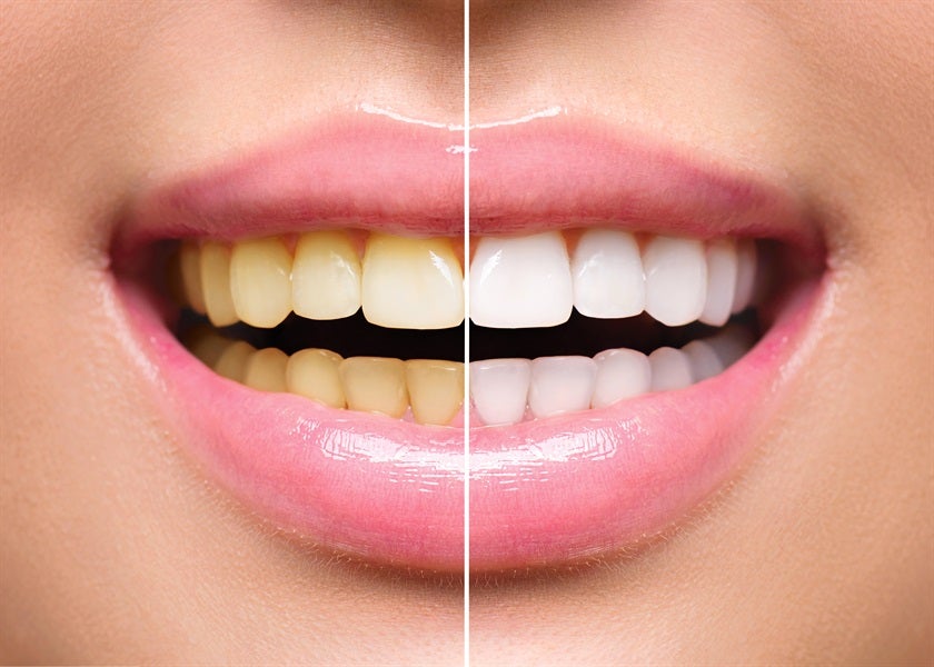 Tooth Whitening At Home