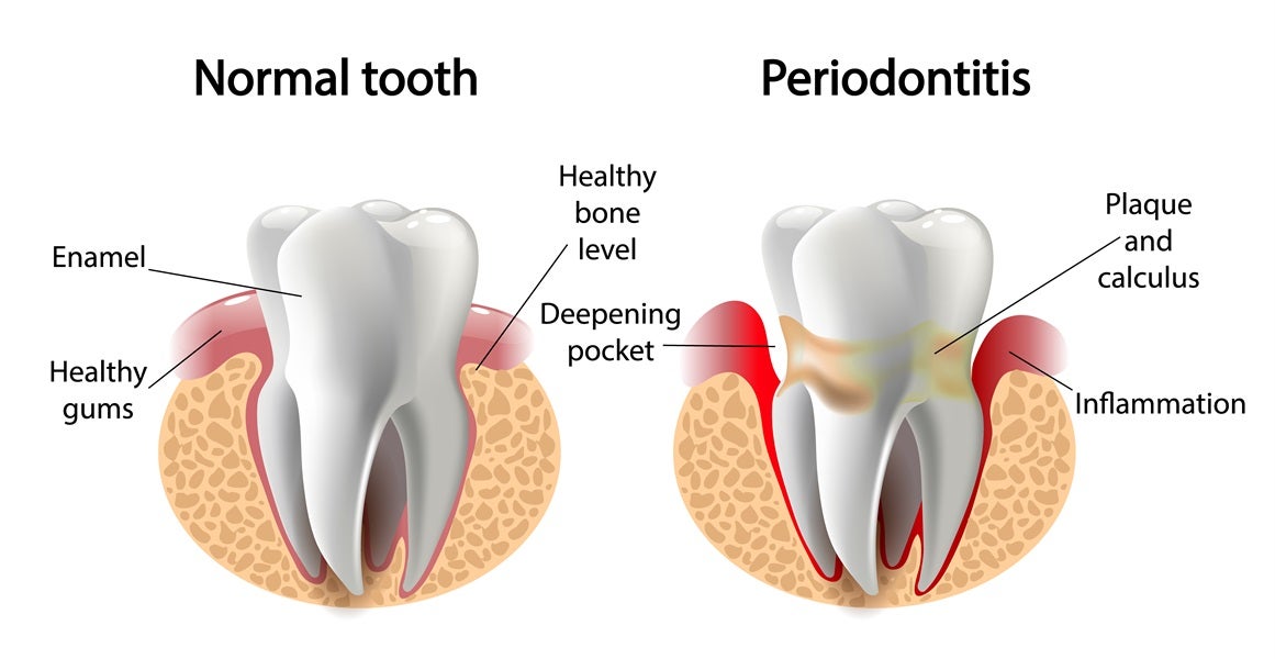  What is a Periodontal Pocket? Is It Bad? Not Exactly...