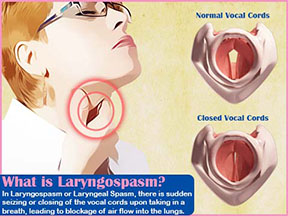 How to Recognize and Treat Laryngospasm