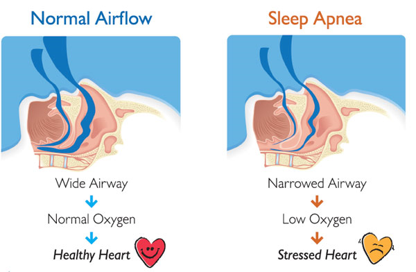 Patient Selection: Obstructive Sleep Apnea