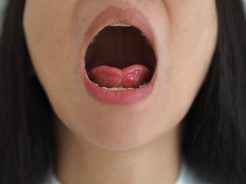Mouth Breathing: A Modern Lifestyle Habit That Causes Gum Disease And Tooth Loss