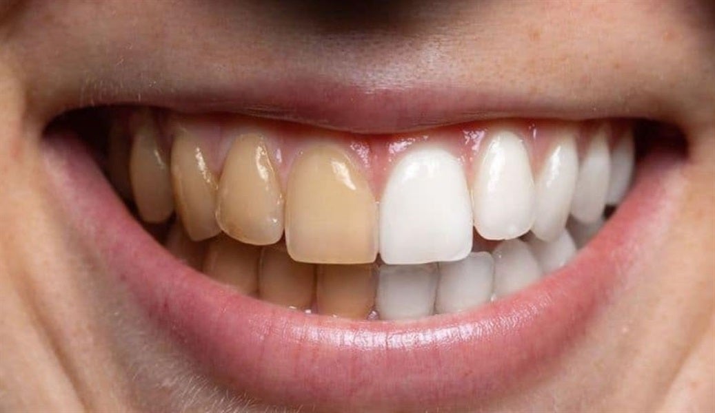 Coffee Stains on Teeth: Why They Happen and How to Beat Them