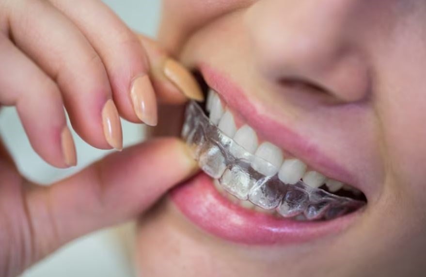 Unlock Your Confidence: Get Invisalign at a Great Price