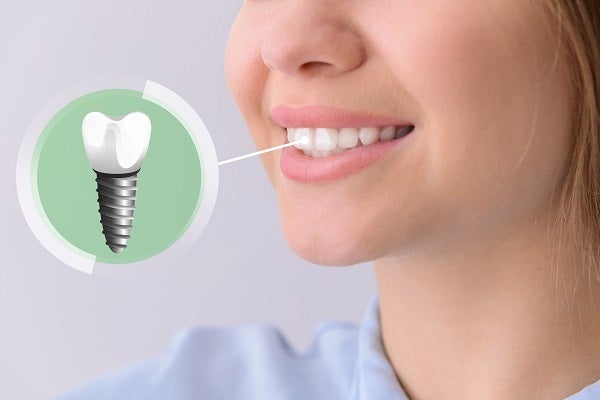 Dental Implants vs. Bridges: Choosing the Right Tooth Replacement