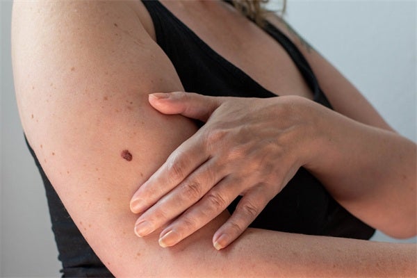 What Dentists Need to Know About Melanoma Cancer
