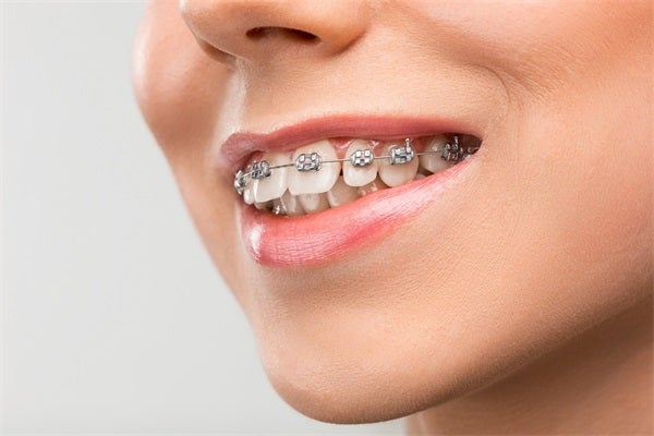 Metal Braces: A Reliable Path to a Perfect Smile