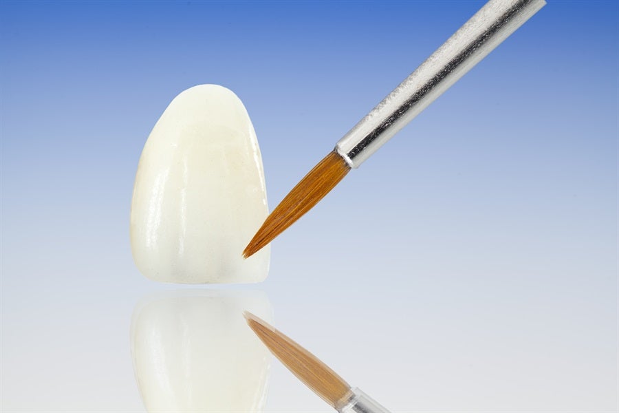 Dental Veneers
