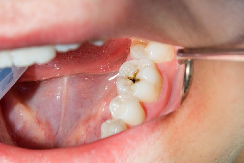 6 Symptoms of Tooth Decay You Need to Know About