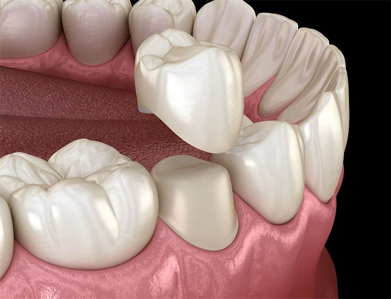 Everything You Need to Know About Dental Crowns