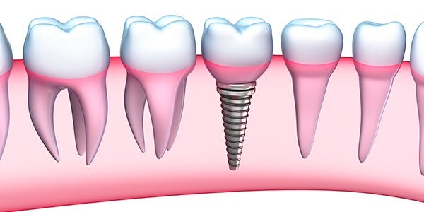 Safe Procedures to Replace Missing Teeth