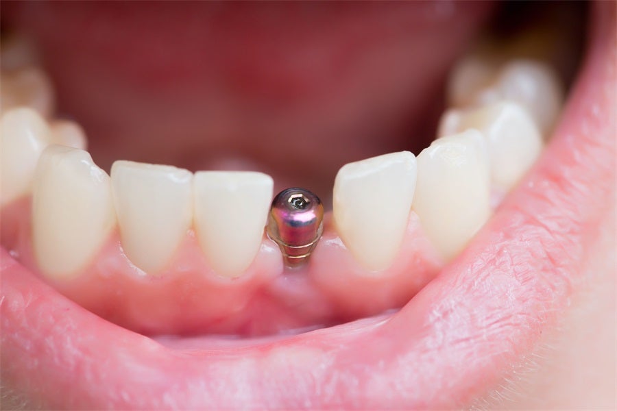 How a Single Dental Implant Can Transform Your Smile