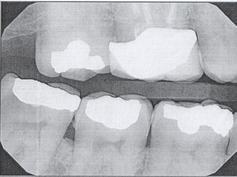 Personal Injury Claim Value for Tooth Damage