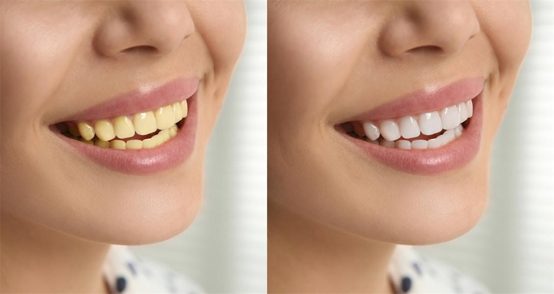 Tooth Discoloration: Causes, Types, and the Best Treatments 