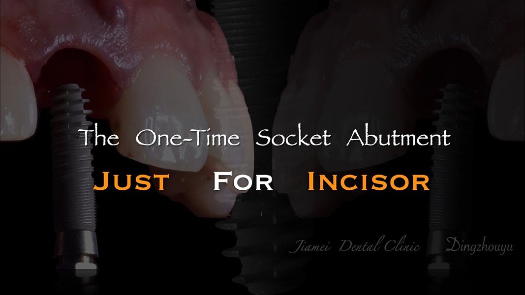 The   One-Time   Socket   Abutment Just    For   Incisor