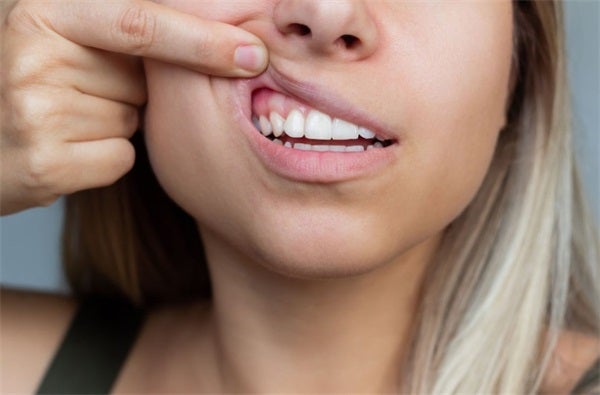 How Winter Weather Can Impact Your Teeth